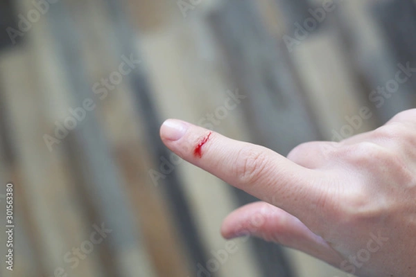 Obraz Finger with blood drop. Injured by sharp knife.