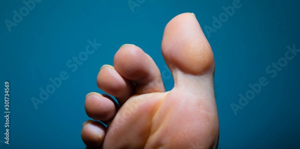 Obraz Athlete foot extreme close up seen from below