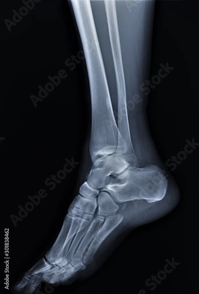 Fototapeta normal radiography of the ankle joint in lateral projection, traumatology and orthopedics, rheumatology