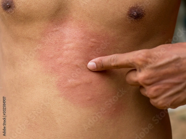 Fototapeta Skin Scratching an itch . Sensitive Skin, Food allergy symptoms, Irritation.