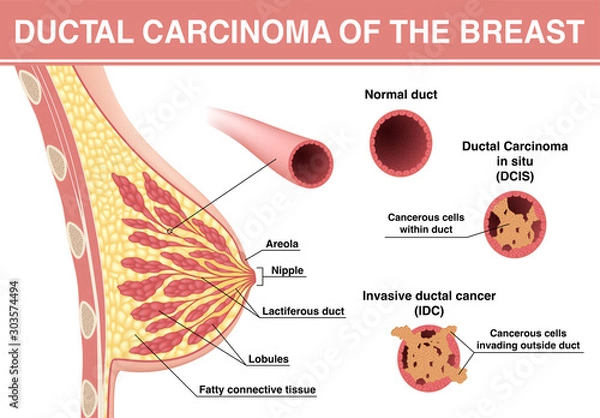 Fototapeta Ductal carcinoma of the breast. DCIS and IDC. Vector illustration showing cross section of female breast and lactiferous duct with different cancer stage.
