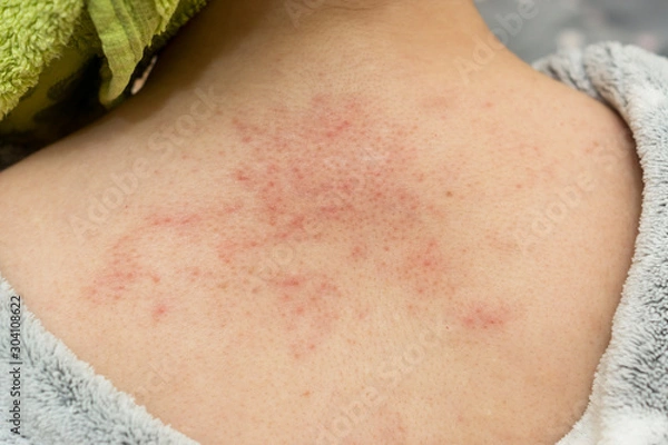 Obraz Allergic rash of pimples on the skin of a back