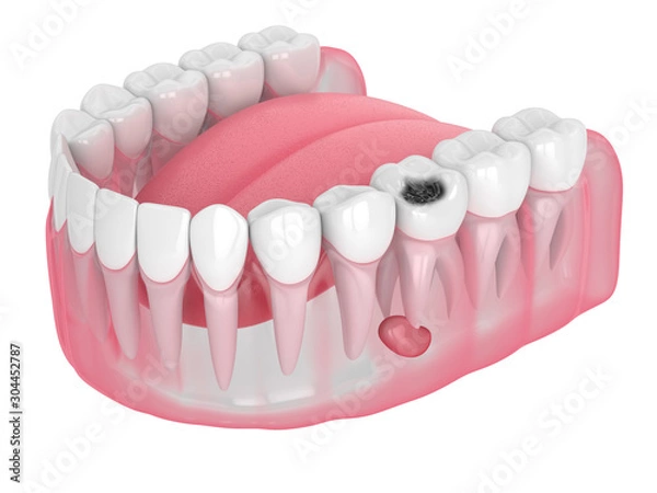 Fototapeta 3d render of jaw with tooth cavity and cyst