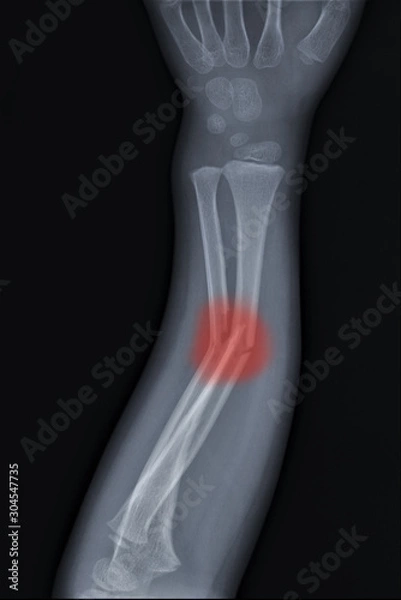 Fototapeta radiography of the forearm with a fracture of the radius and ulna, Traumatology and orthopedics, traumatology