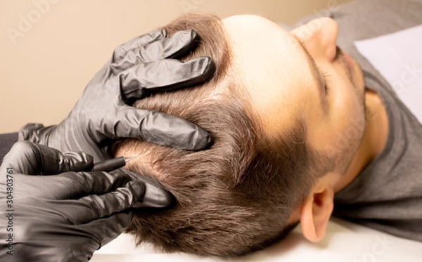 Fototapeta Male trichopigmentation service. Young man laying on the back on the esthetician table. Master hands in a black gloves holding the permanent makeup machine with the needle and touching mans hair.