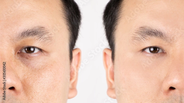 Fototapeta Close up of middle aged Asian man face with wrinkles, sun damage, dark circles under the eyes, before and after procedures.