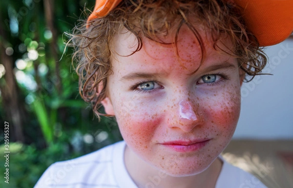 Obraz red painful skin, sunburn on the boy's face, sunburn protection need, close-up face of a cute caucasian boy with a sunscreen on his nose, which burned in the sun, freckles face