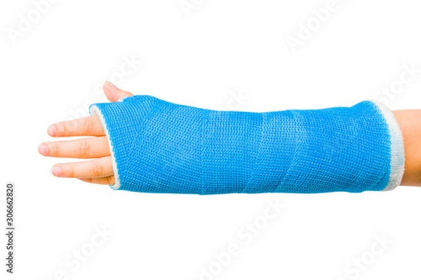 Fototapeta Cast of Child’s Broken Arm Isolated on White Background
