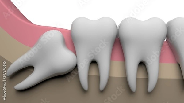 Fototapeta Wisdom tooth horizontal, 3D-rendering, white background