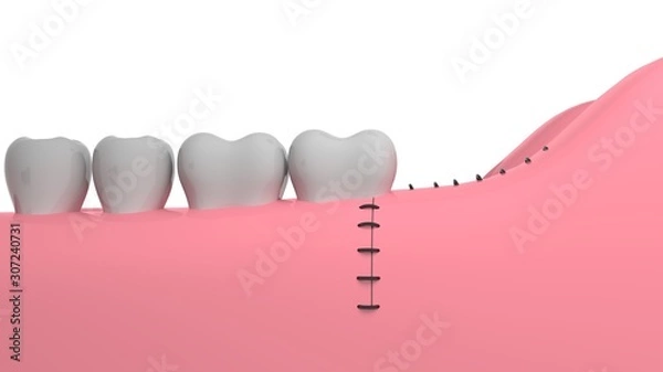 Obraz Wisdom tooth removing, 3D-rendering, white background