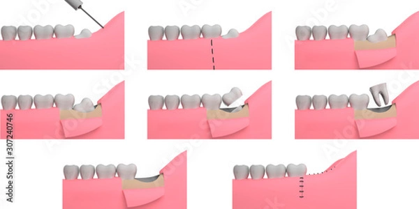 Obraz Wisdom tooth removing, collage, 3D-rendering, white background