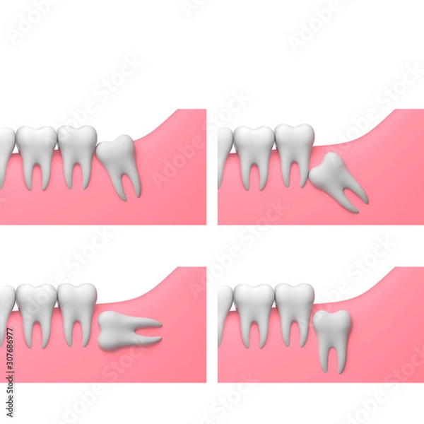 Fototapeta Types of wisdom tooth impactions, white background, collage, 3D-render illustration
