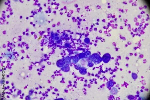 Fototapeta Mononuclear and multinucleated cell (Tzanck smear ,Abnormal Human cells , Medical technologist)