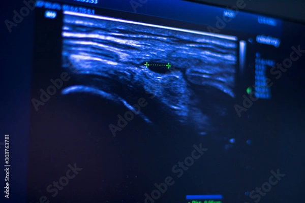 Obraz EPI dry needling ultrasound scan