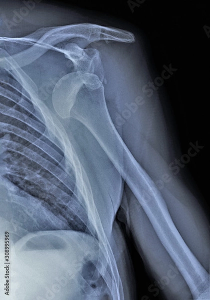 Fototapeta x ray of the shoulder joint with dislocation of the head of the humerus