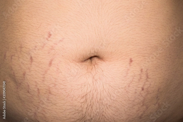 Fototapeta A man is overweight all over his body, on his stomach, chest, arms. Stretch marks on the abdomen in the process of losing weight.