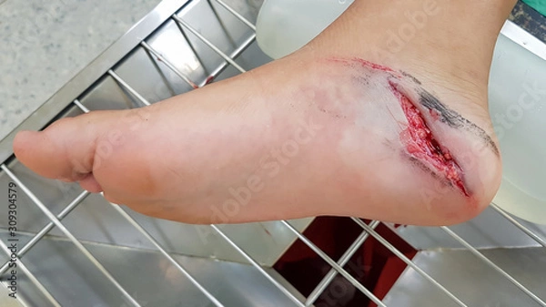 Fototapeta accident wound on foot patient, sterile technique, infection control and dressing process