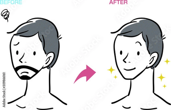 Obraz ヒゲ 脱毛 男性 泥棒ヒゲ ビフォーアフター ベクター