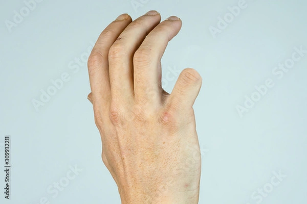 Obraz caucasian man hand with amputaded Little finger isolated on White background 