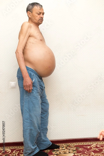 Obraz ascitic disease in man