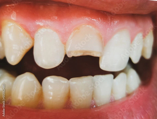 Fototapeta Broken tooth. Broken upper incisor in a man mouth.
