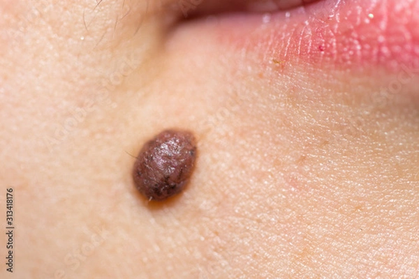 Obraz beautiful, female, red lips and mole close-up