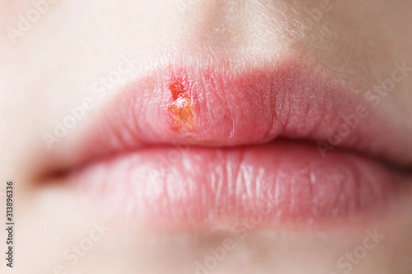 Obraz herpes simplex