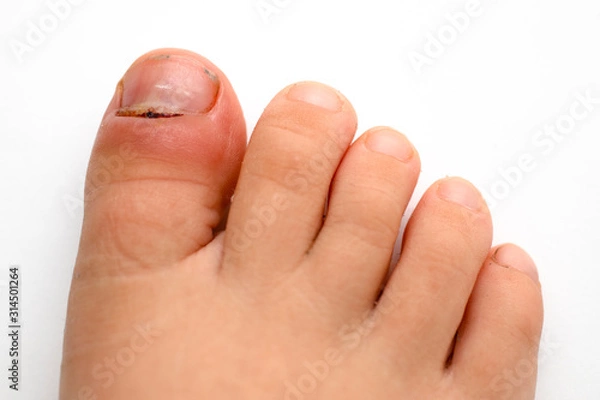 Fototapeta inflammation01