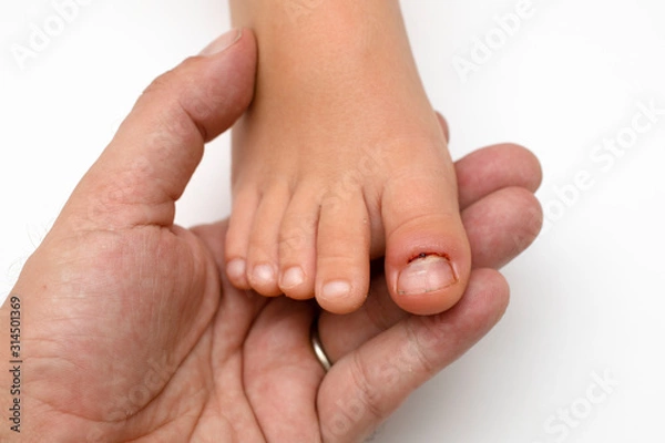 Fototapeta inflammation03