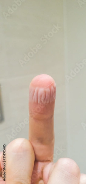 Obraz Skin Maceration on a white adult males hand after leaving a plaster or band aid on over night after a cut
