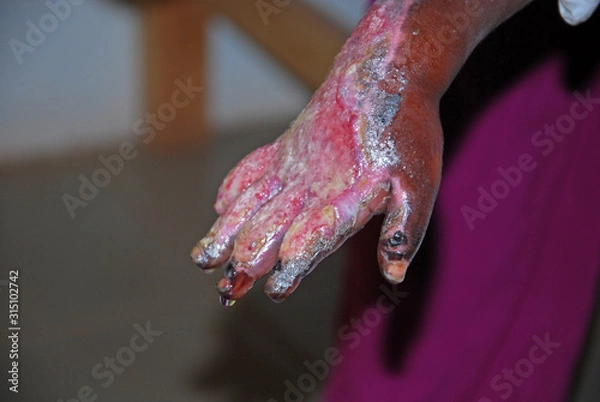 Obraz The serious burns to a hand of a child African-Tanzania-Africa