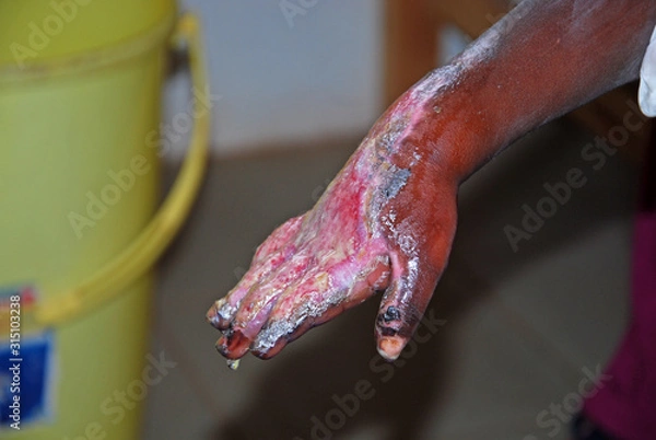 Obraz The serious burns to a hand of a child African-Tanzania-Africa