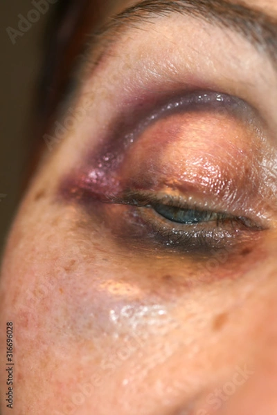 Fototapeta A bruise near the eye. Hematoma on the face from a blow. Eye injury.