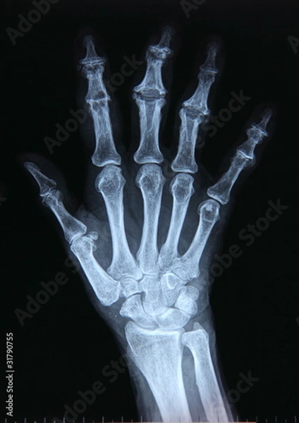 Obraz X-ray / Hand