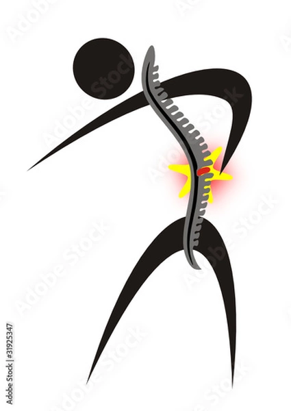 Obraz bandscheibenvorfall