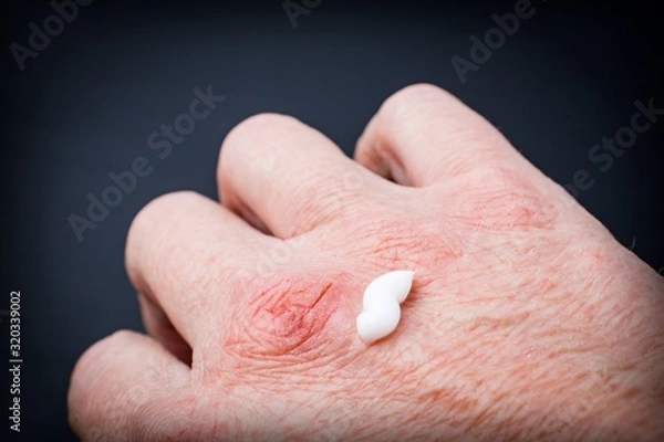 Fototapeta White cream on hand with chapped skin due to exposure to cold