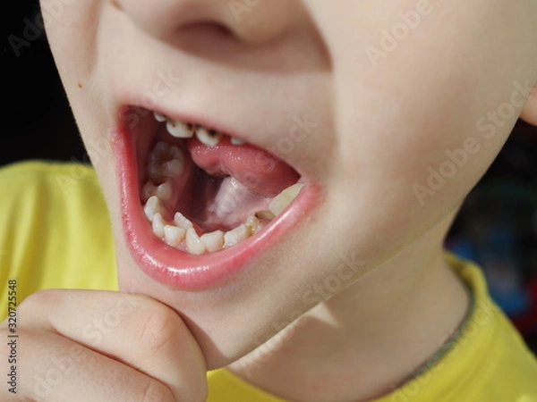 Fototapeta Abnormal boy tooth. The extra narrow strange tooth grew in the boy's mouth. Boy shows his crooked tooth. Patient Orthodontist. Children's teeth problems