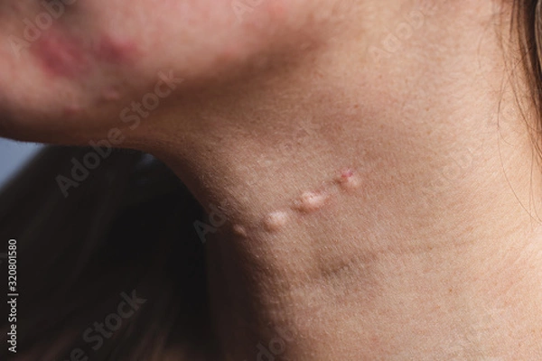 Obraz Real skin Biorevitalization. Traces of biorevitalization injections on the neck. Biorevitalization needle marks on the neck