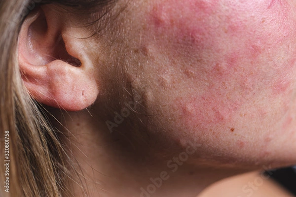 Obraz Real skin Biorevitalization. Traces of biorevitalization injections on the neck. Biorevitalization needle marks on the face