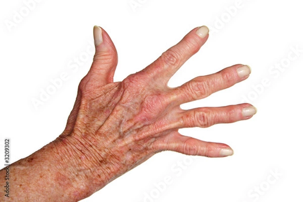 Obraz arthritis hand
