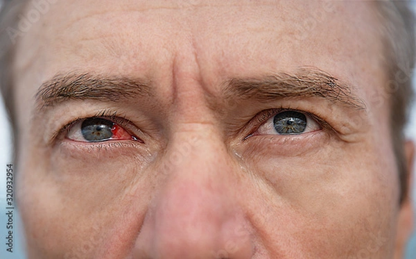 Obraz Man's sore eye with conjunctivitis. Closeup irritated infected red bloodshot eye