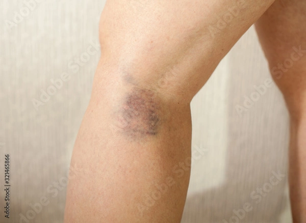 Fototapeta Dark blue, black bruise on the back of the female leg as a result of a ruptured vessel. A vein burst on the leg. Tissue injury