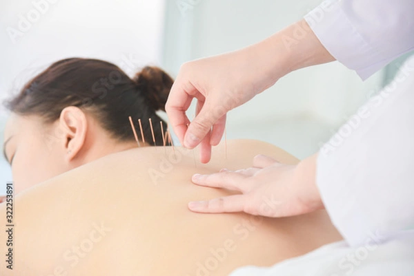 Obraz Hands of therapist doing acupuncture at patient back ,Alternative medicine concept.