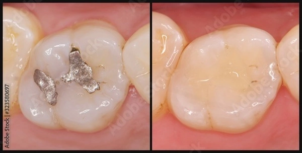Fototapeta 銀歯　セラミック　歯科治療