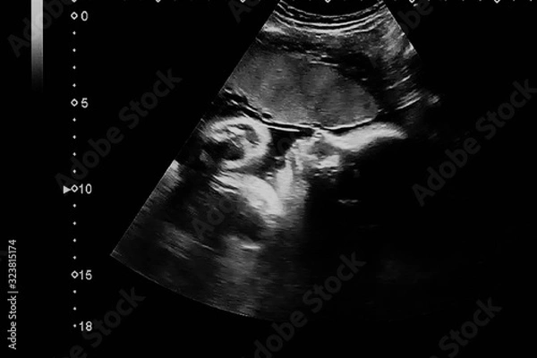 Fototapeta Face profile of the baby fetus in 35 weeks of pregnancy, ultrasound image of baby's head with his little hand