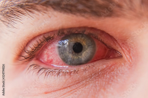 Fototapeta Macro closeup of  conjunctivitis infeced red eye