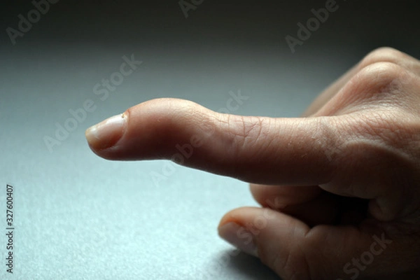 Fototapeta Mallet finger injury