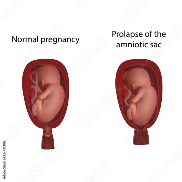 Obraz Normal and prolapse of the amniotic sac. Cervical weakness. Fetus in uterus, womb, placenta, umbilical cord. Hi-risk pregnancy complications. Medical anatomy illustration.