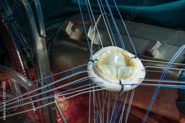 Obraz Heart valve prosthesis. Close up image of aortic valve implant during open heart surgery.