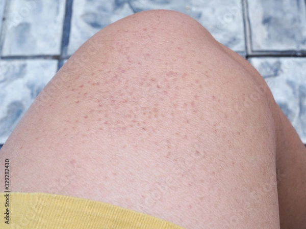Fototapeta skin problems with large and dark pores on leg.